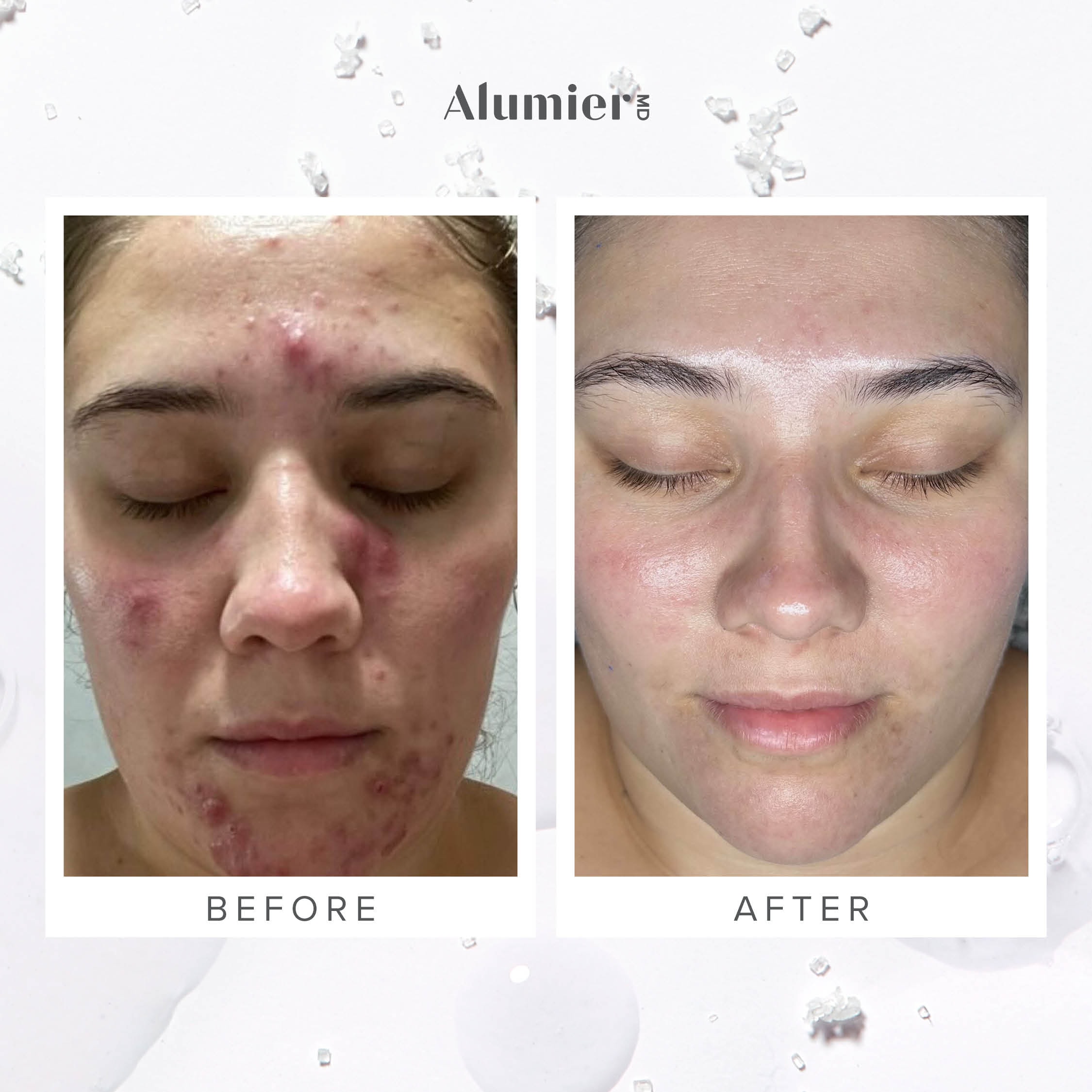 AlumierMD before and after acne treatment results